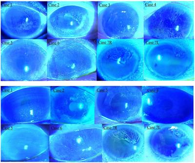 Case report: Medical treatment for limbal epithelial stem cell deficiency in patients treated for glaucoma